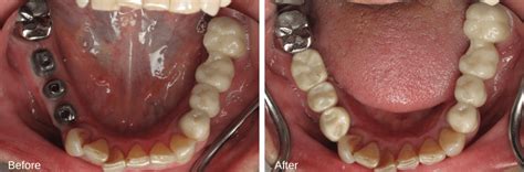 multiple dental implants burbank